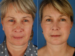 Rhinoplasty Before and After Photos in Naples, FL, Patient 11632