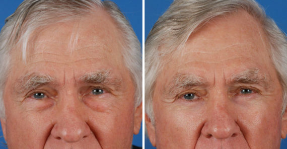 Blepharoplasty Before and After Photos in Naples, FL, Patient 8284