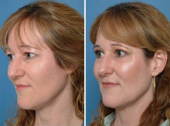 Blepharoplasty Before and After Photos in Naples, FL, Patient 8255