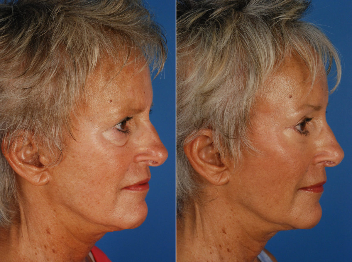 Fat Transfer Before and After Photos in Naples, FL, Patient 10936