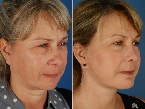 Rhinoplasty Before and After Photos in Naples, FL, Patient 11632