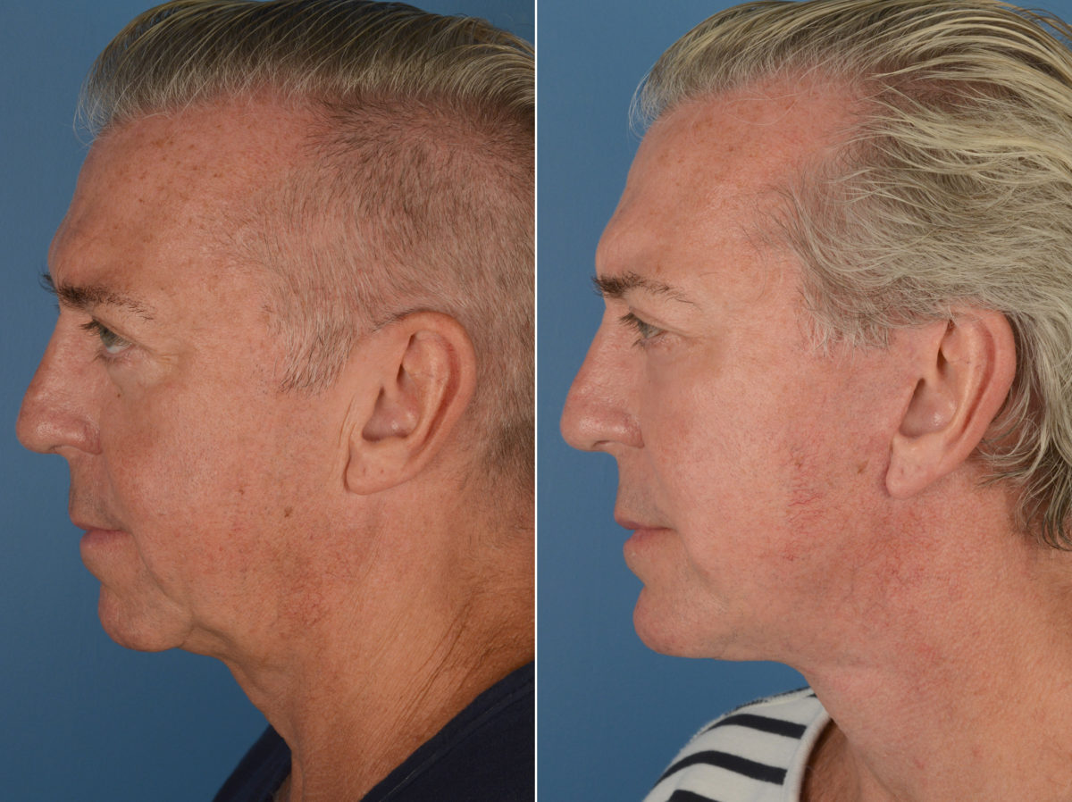 Fat Transfer Before and After Photos in Naples, FL, Patient 12081