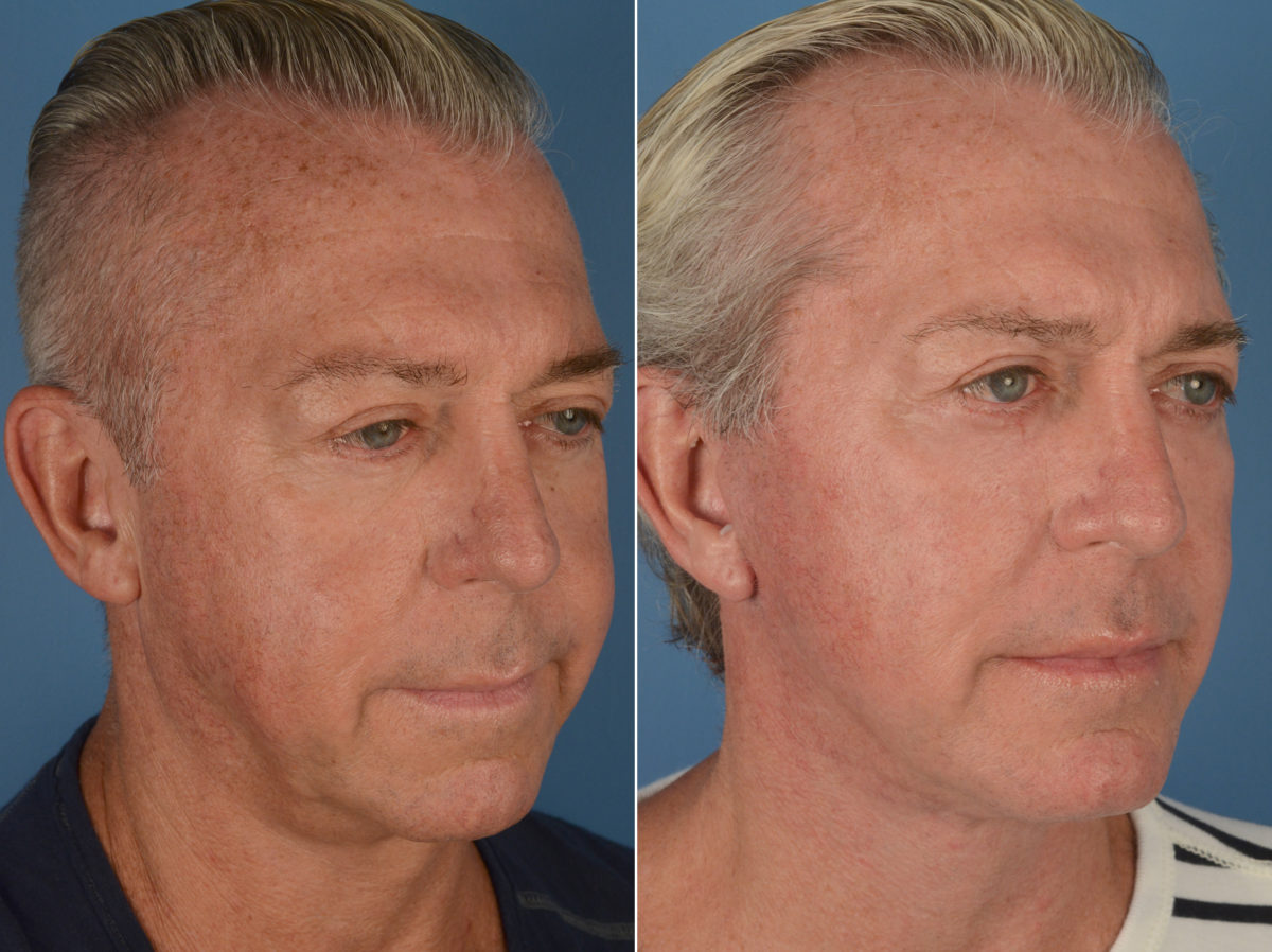 Fat Transfer Before and After Photos in Naples, FL, Patient 12081