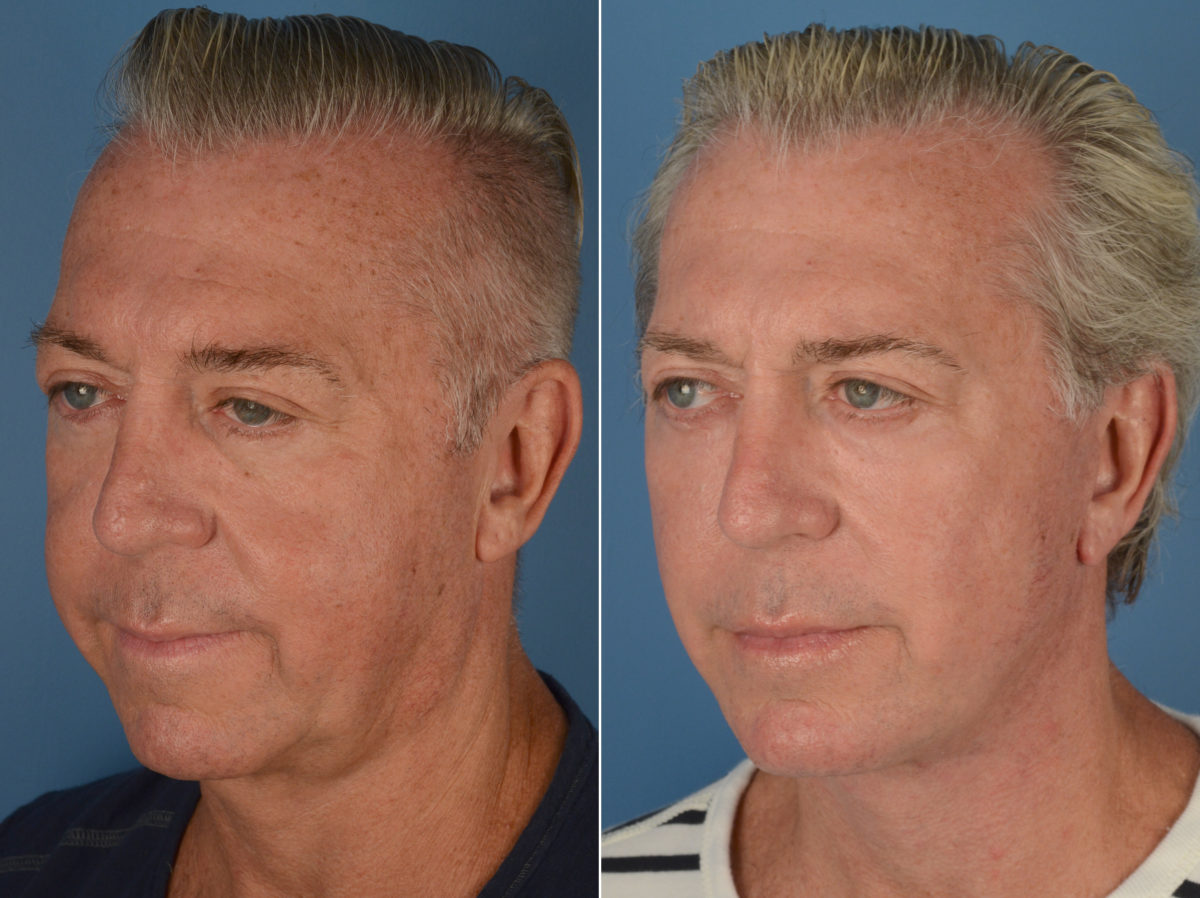 Fat Transfer Before and After Photos in Naples, FL, Patient 12081