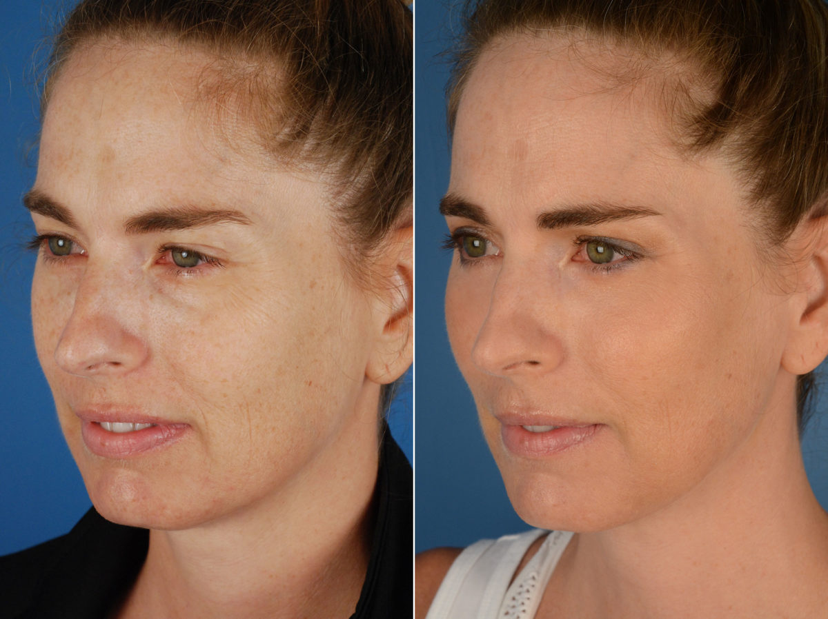 Fat Transfer Before and After Photos in Naples, FL, Patient 11886
