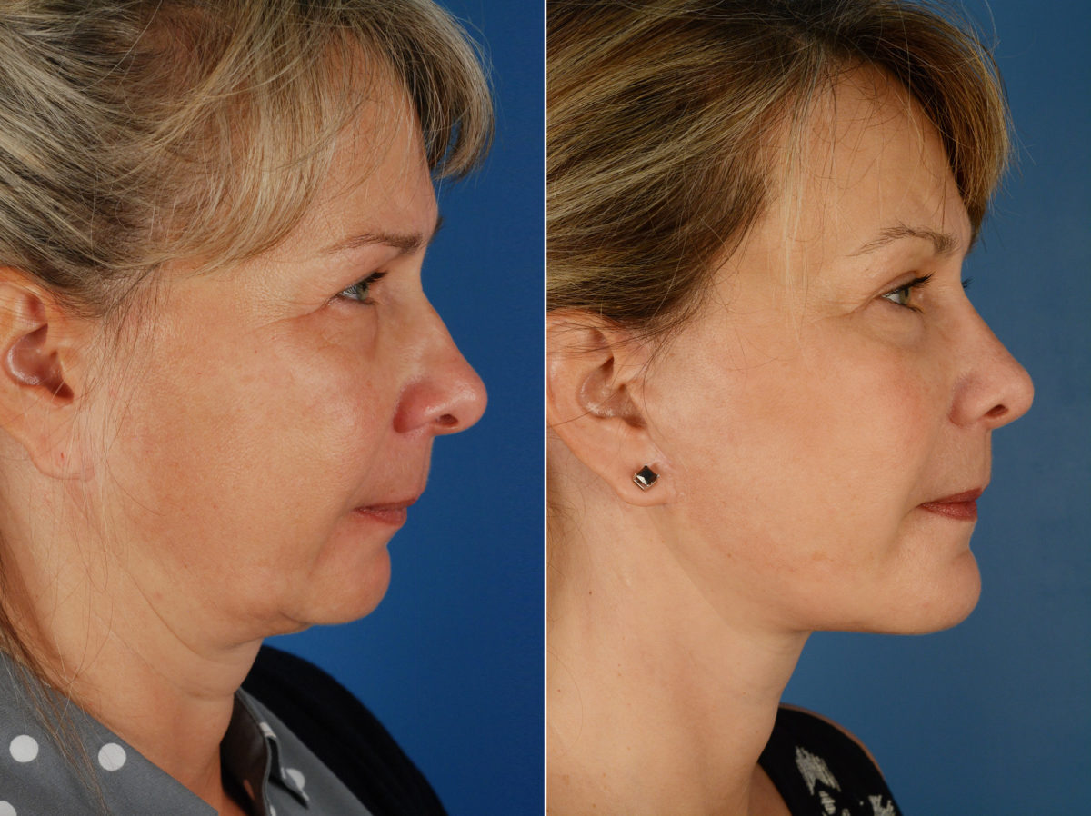 Rhinoplasty Before and After Photos in Naples, FL, Patient 11632