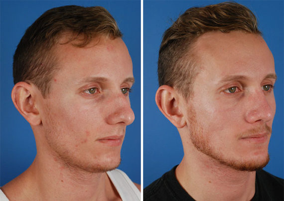 Rhinoplasty Before and After Photos in Naples, FL, Patient 8747