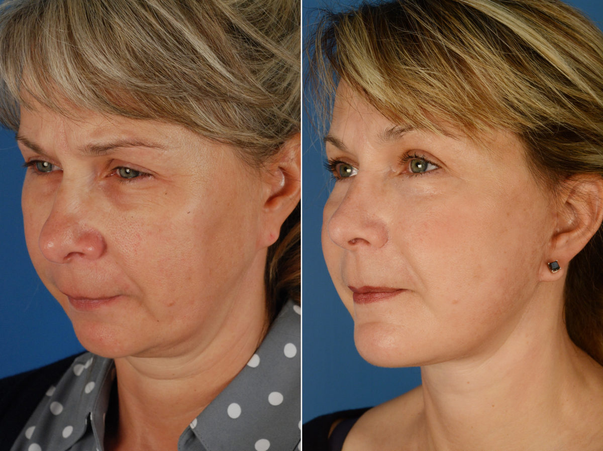 Rhinoplasty Before and After Photos in Naples, FL, Patient 11632