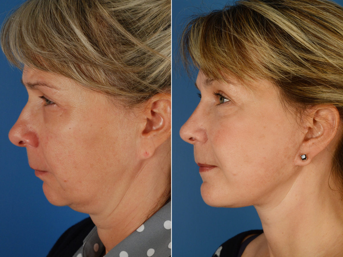 Rhinoplasty Before and After Photos in Naples, FL, Patient 11632