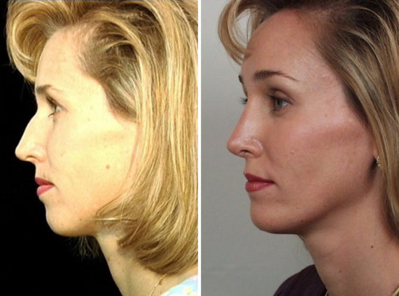 Rhinoplasty Before and After Photos in Naples, FL, Patient 8670