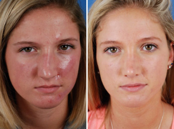 Rhinoplasty Before and After Photos in Naples, FL, Patient 8673