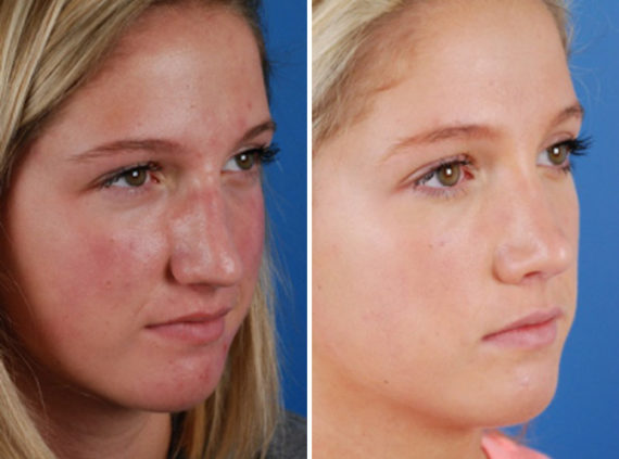 Rhinoplasty Before and After Photos in Naples, FL, Patient 8673