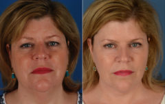 The UpLift™ Lower Face and Neck Lift Before and After Photos in Naples, FL, Patient 11683