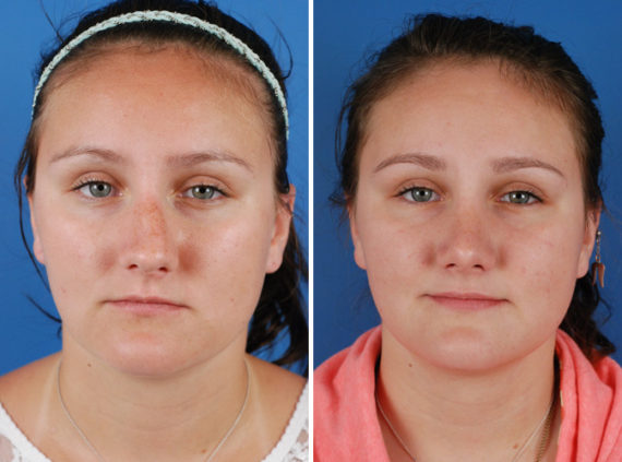 Rhinoplasty Before and After Photos in Naples, FL, Patient 8685