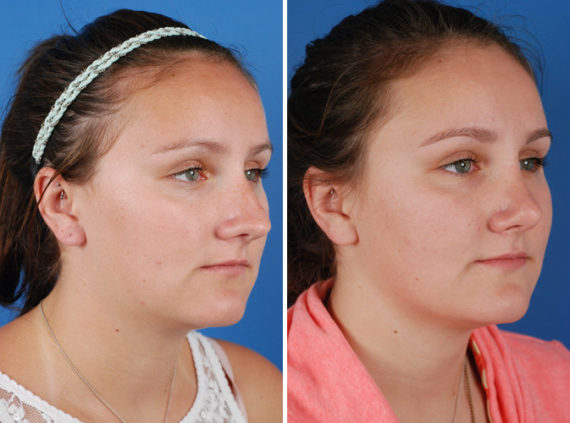 Rhinoplasty Before and After Photos in Naples, FL, Patient 8685