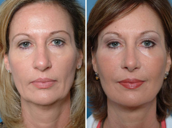 Rhinoplasty Before and After Photos in Naples, FL, Patient 8692