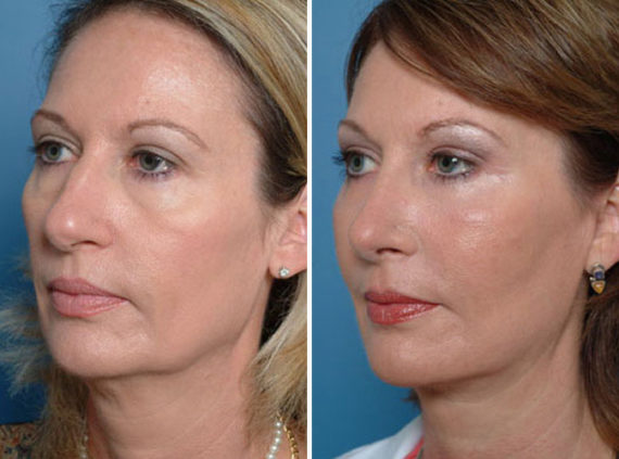 Rhinoplasty Before and After Photos in Naples, FL, Patient 8692