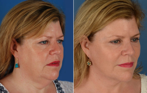 The UpLift™ Lower Face and Neck Lift Before and After Photos in Naples, FL, Patient 11683