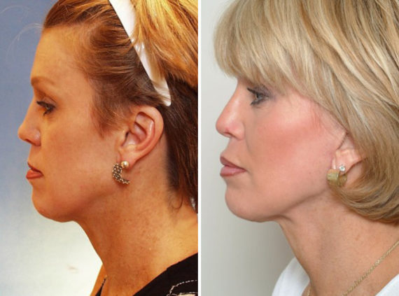 Rhinoplasty Before and After Photos in Naples, FL, Patient 8709