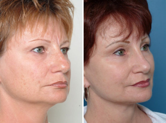 Rhinoplasty Before and After Photos in Naples, FL, Patient 8704