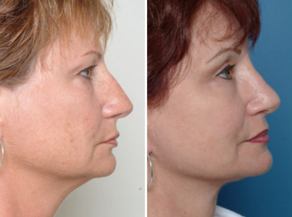 Rhinoplasty Before and After Photos in Naples, FL, Patient 8704