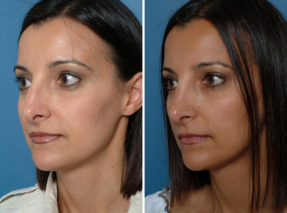 Rhinoplasty Before and After Photos in Naples, FL, Patient 8680