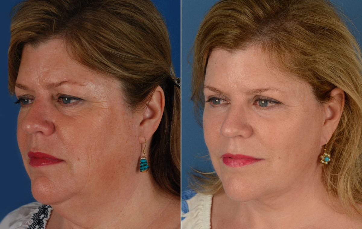 The UpLift™ Lower Face and Neck Lift Before and After Photos in Naples, FL, Patient 11683