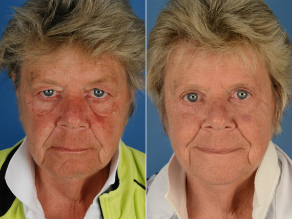 Blepharoplasty Before and After Photos in Naples, FL, Patient 12284