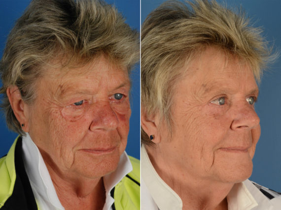 Blepharoplasty Before and After Photos in Naples, FL, Patient 12284