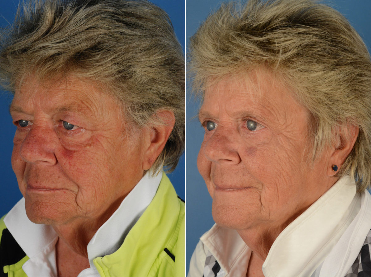 Blepharoplasty Before and After Photos in Naples, FL, Patient 12284