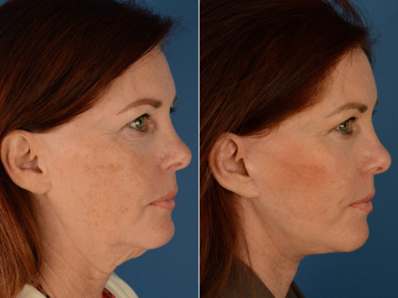 The UpLift™ Lower Face and Neck Lift Before and After Photos in Naples, FL, Patient 12688