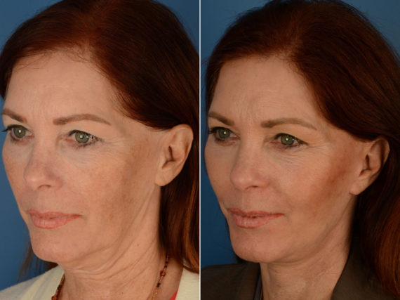 The UpLift™ Lower Face and Neck Lift Before and After Photos in Naples, FL, Patient 12688