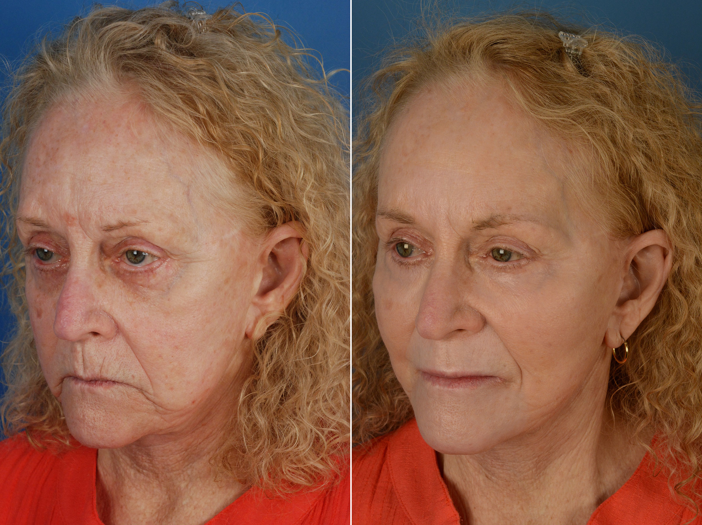 Blepharoplasty Photos Naples Fl Patient 12674