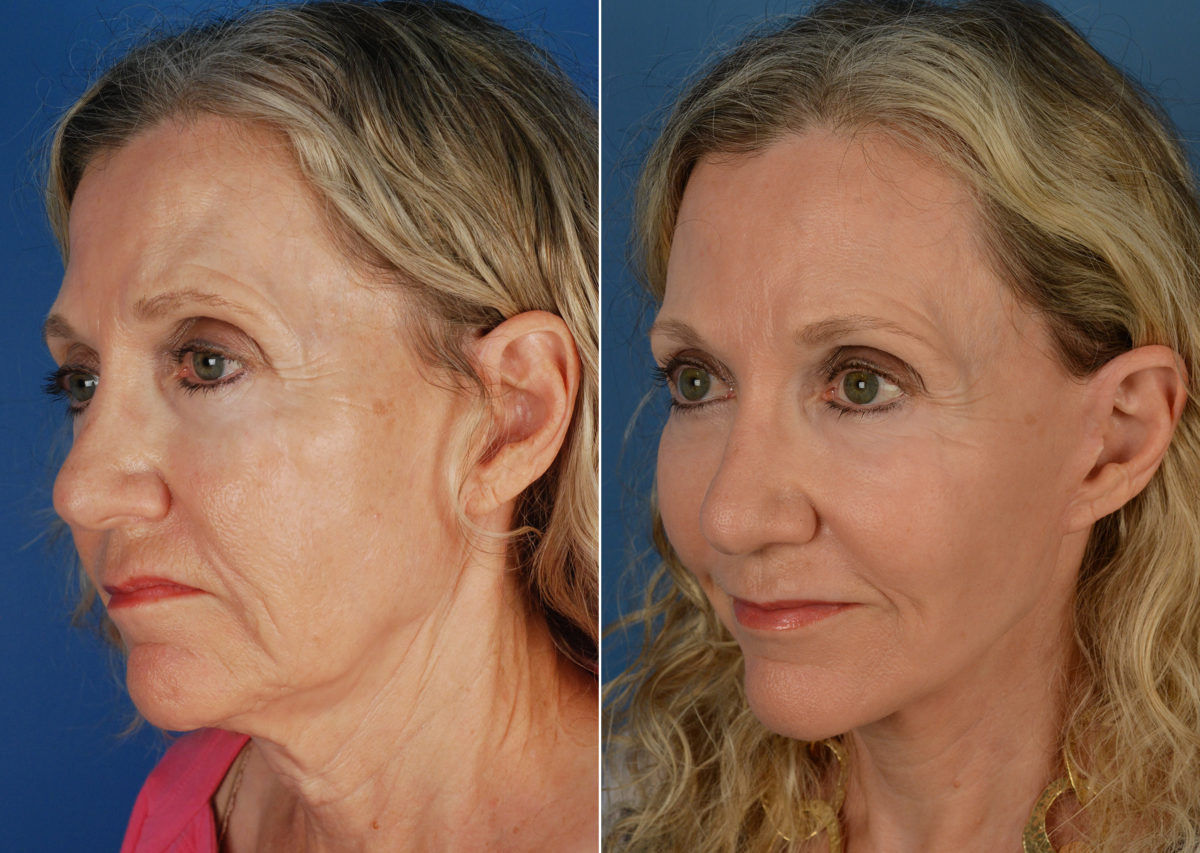 Fat Transfer Before and After Photos in Naples, FL, Patient 11255