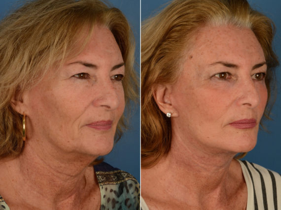 The UpLift™ Lower Face and Neck Lift Before and After Photos in Naples, FL, Patient 12782