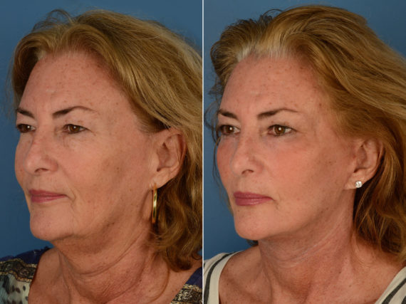 The UpLift™ Lower Face and Neck Lift Before and After Photos in Naples, FL, Patient 12782