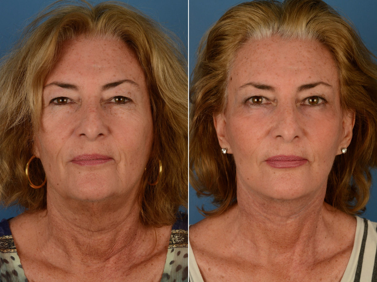 The UpLift™ Lower Face and Neck Lift Before and After Photos in Naples, FL, Patient 12782