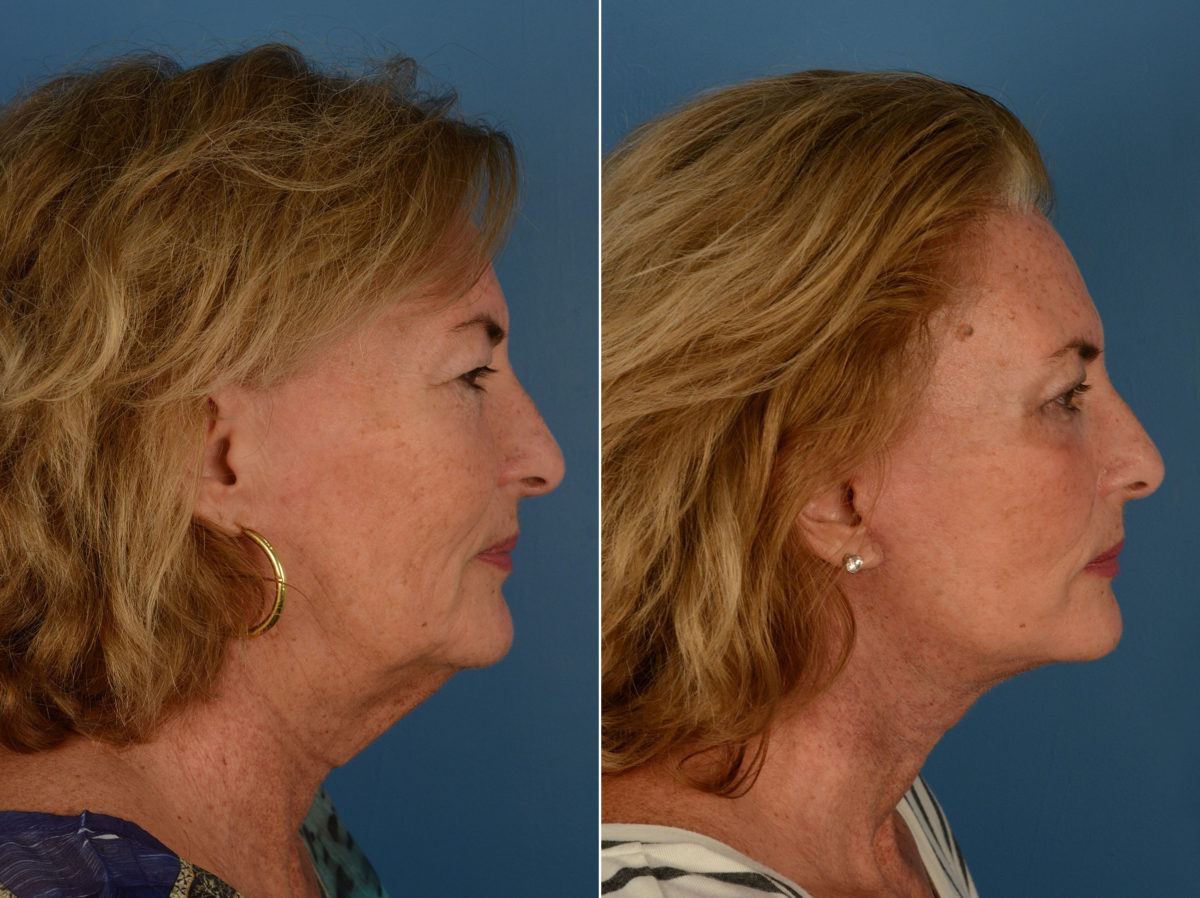 The UpLift™ Lower Face and Neck Lift Before and After Photos in Naples, FL, Patient 12782