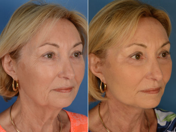 The UpLift™ Lower Face and Neck Lift Before and After Photos in Naples, FL, Patient 12803