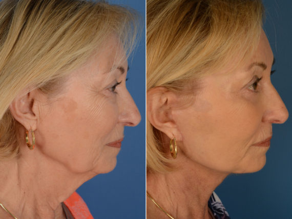 The UpLift™ Lower Face and Neck Lift Before and After Photos in Naples, FL, Patient 12803