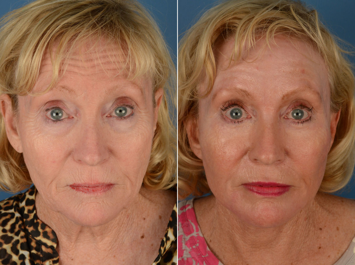 The UpLift™ Lower Face and Neck Lift Before and After Photos in Naples, FL, Patient 12847