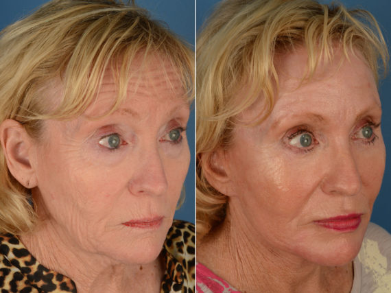 The UpLift™ Lower Face and Neck Lift Before and After Photos in Naples, FL, Patient 12847