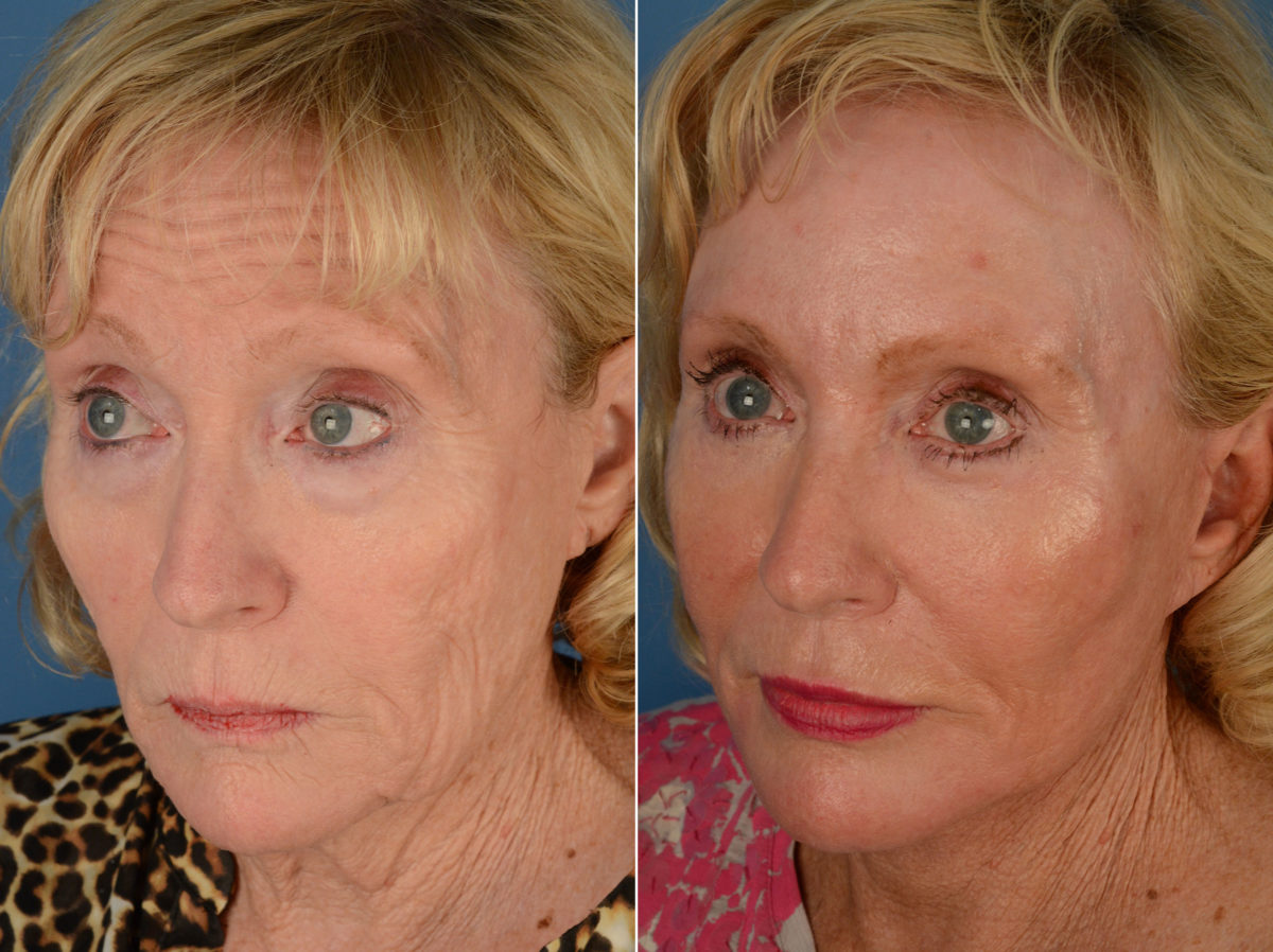 The UpLift™ Lower Face and Neck Lift Before and After Photos in Naples, FL, Patient 12847