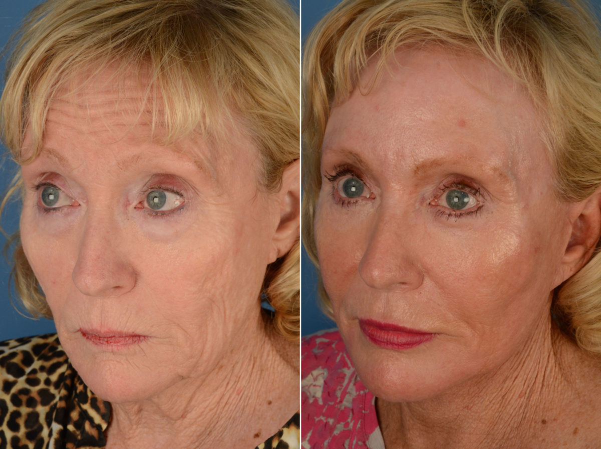 The UpLift™ Lower Face and Neck Lift Before and After Photos in Naples, FL, Patient 12847