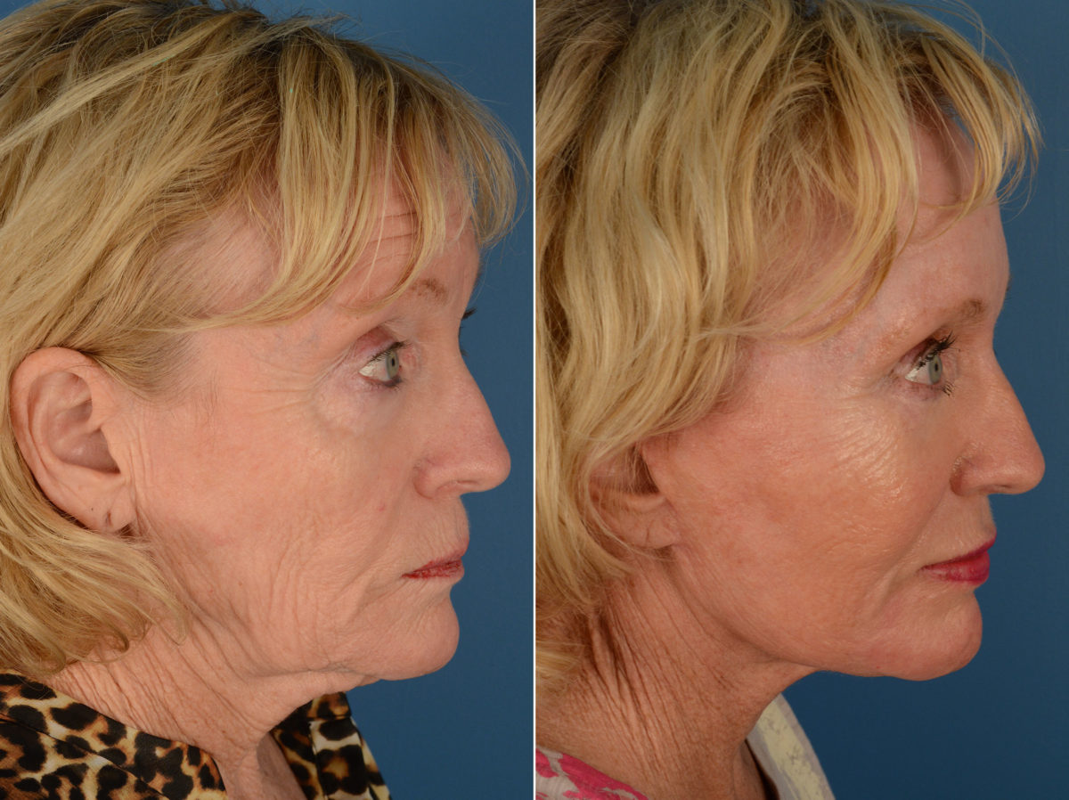 The UpLift™ Lower Face and Neck Lift Before and After Photos in Naples, FL, Patient 12847