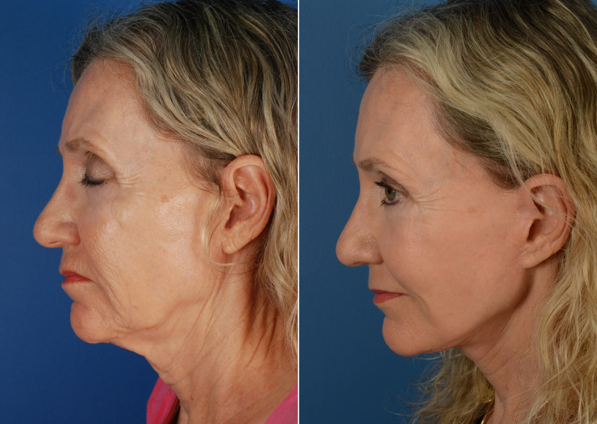 Fat Transfer Before and After Photos in Naples, FL, Patient 11255