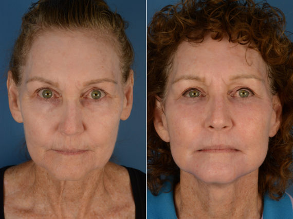 The UpLift™ Lower Face and Neck Lift Before and After Photos in Naples, FL, Patient 12920