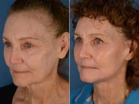 The UpLift™ Lower Face and Neck Lift Before and After Photos in Naples, FL, Patient 12920