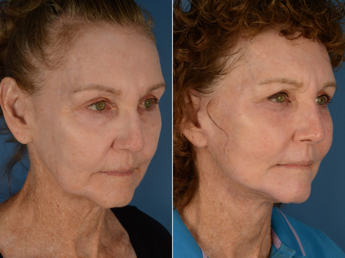 The UpLift™ Lower Face and Neck Lift Before and After Photos in Naples, FL, Patient 12920