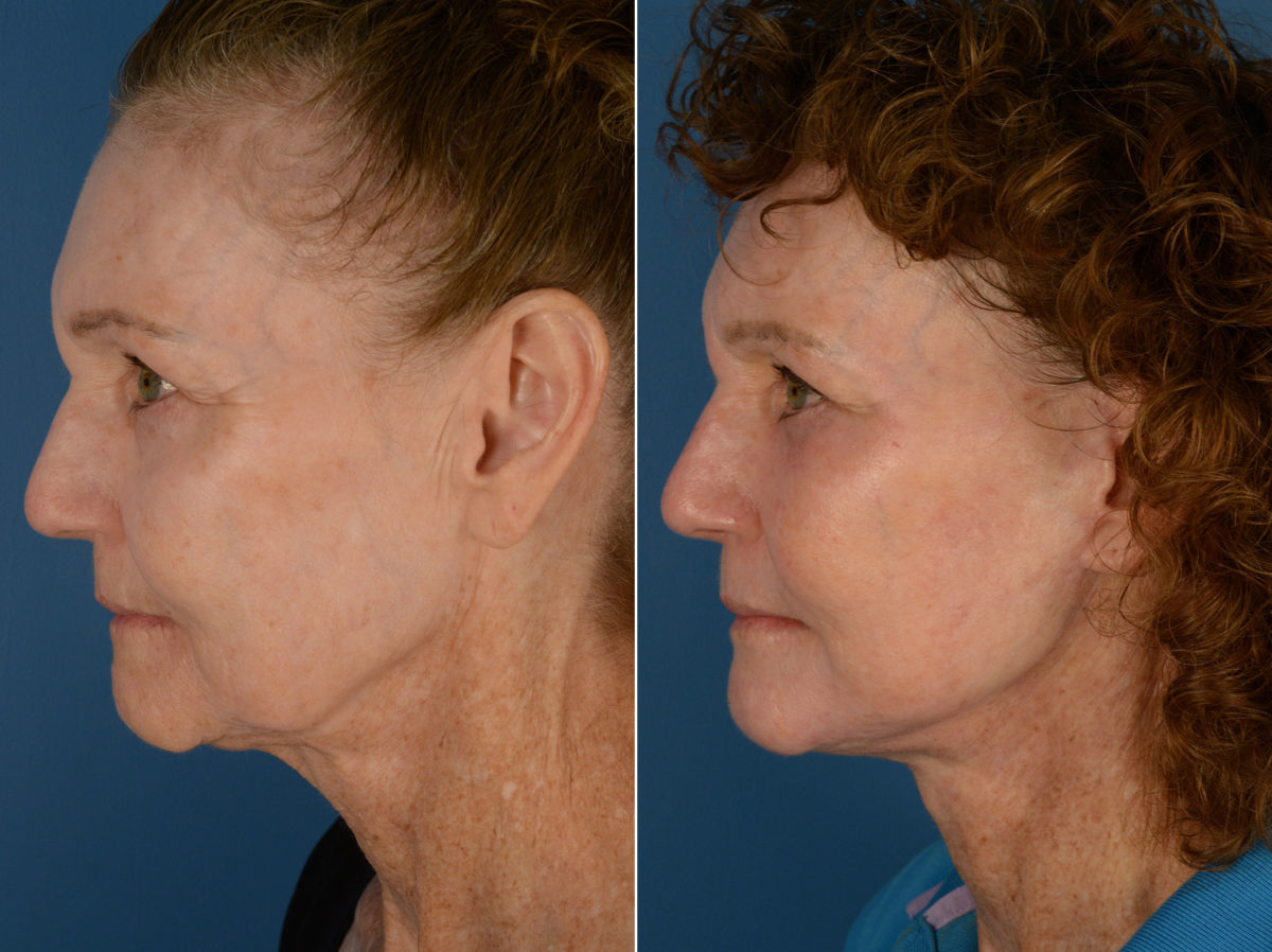 The UpLift™ Lower Face and Neck Lift Before and After Photos in Naples, FL, Patient 12920